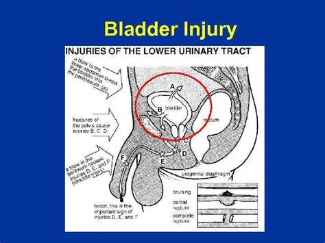 20k bladder tear test|traumatic bladder injury statistics.